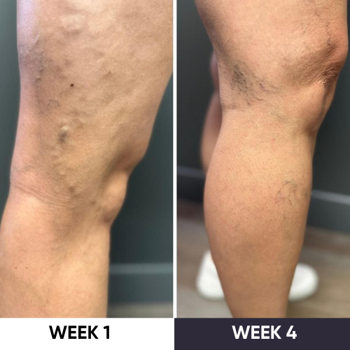 ZAKDAVI™ VeinErase System