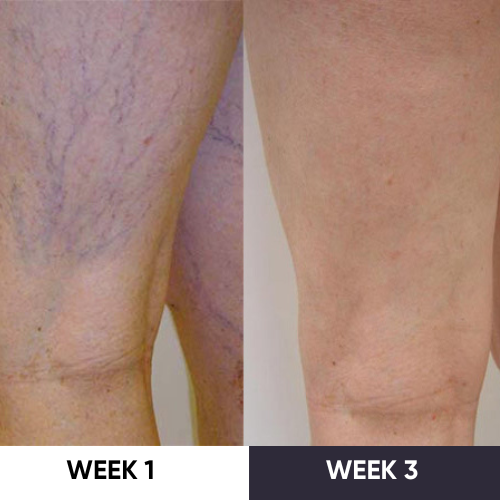 ZAKDAVI™ VeinErase System