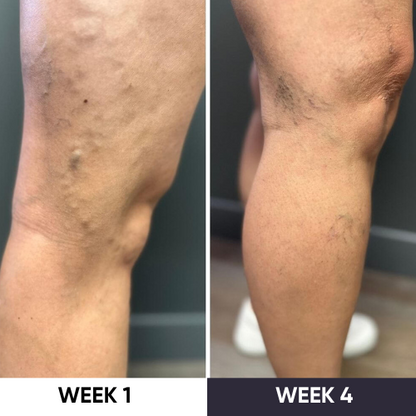 ZAKDAVI™ VeinErase System