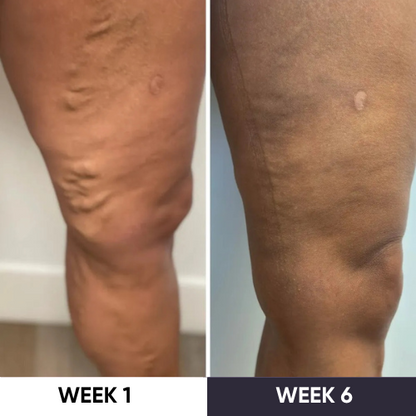 ZAKDAVI™ VeinErase System