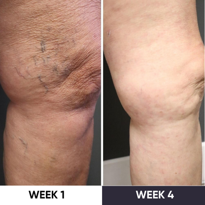 ZAKDAVI™ VeinErase System